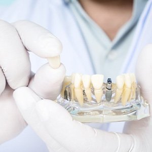 Dentist holding the crown portion of an implant restoration