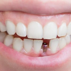 Person smiling to reveal a dental implant post