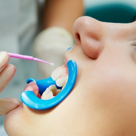 Close up of dental patient having fluoride applied to their teeth