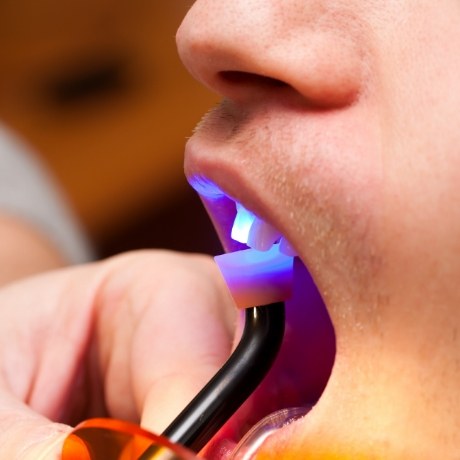 Close up of dental patient receiving cosmetic bonding on upper front tooth