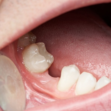 Close up of a mouth with a missing tooth