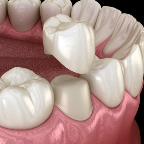 Illustrated dental crown being fitted over a tooth
