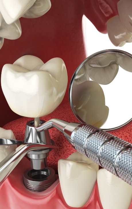 Illustrated dental implant with abutment and crown being placed in lower jaw