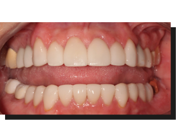 Close up of mouth with whiter newly restored teeth