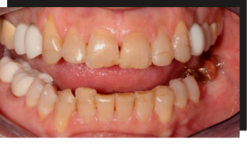 Close up of mouth with discolored and slightly damaged teeth