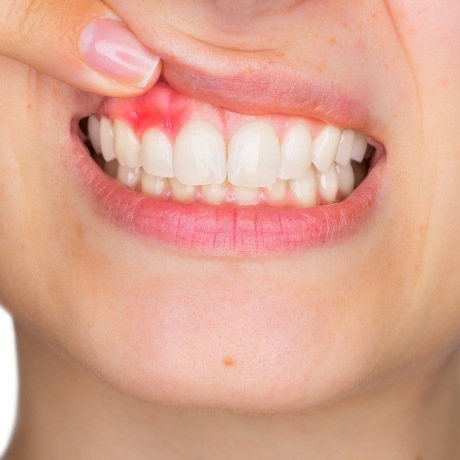 Person pointing to red spot in their gums