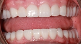Close up of mouth with restored lower teeth