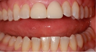 Mouth with a full set of undamaged teeth