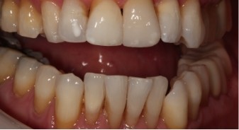 Mouth with more well aligned teeth