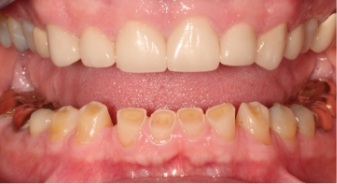 Close up of mouth with damaged lower teeth