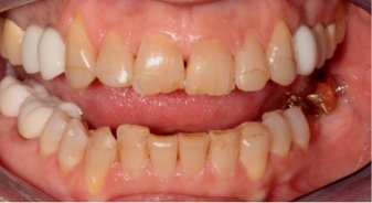 Mouth with several darkened and damaged teeth