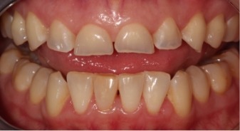 Mouth with stubby and yellowed teeth