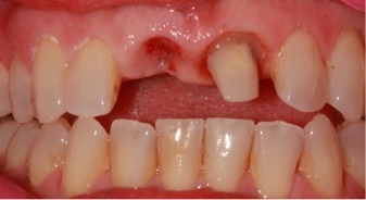 Mouth with a missing upper tooth and a few damaged teeth