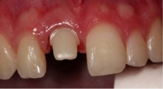 Close up of worn down tooth