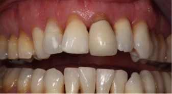 Mouth with slightly misaligned teeth