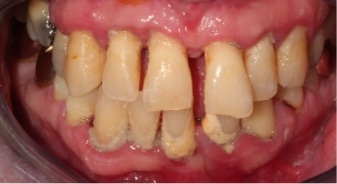 Mouth with yellow and gapped teeth